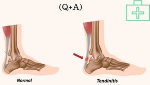 Achilles Tendon Injury, causes symptoms and treatments