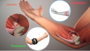 Tennis elbow injury, causes, symptoms and treatment